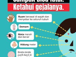Dinkes Jabar Imbau Masyarakat Waspadai Penularan Campak Saat Mudik Idulfitri